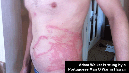 Adam Walker is stung by a Portuguese Man O War